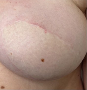 Areola tetoválás előtte – areola hiánya rekonstrukció után
