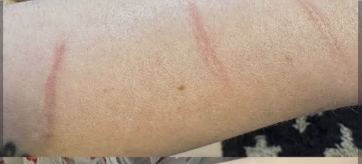 Hegfedő tetoválás előtte – látható heg a karon