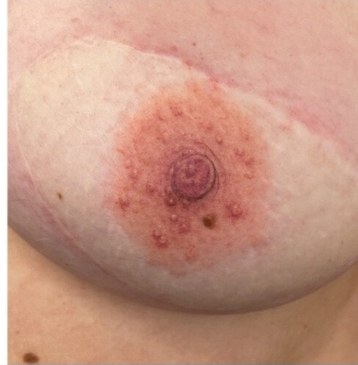 Areola tetoválás utána – természetes hatású areola és mellbimbó